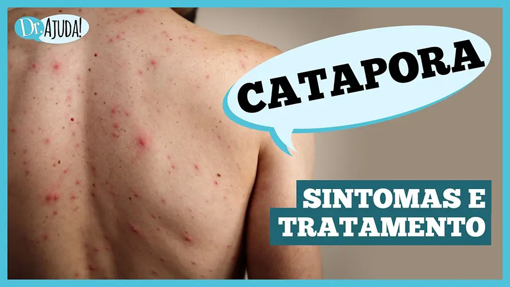 Catapora: sintomas, complicações e prevenção 1 Catapora